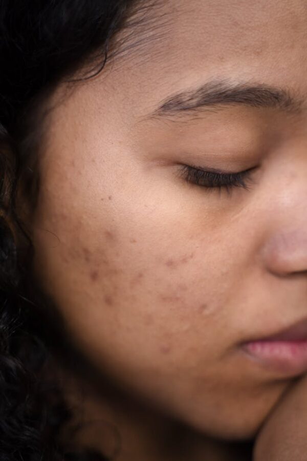 Acne photo